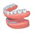 Phuket Implant Dentures